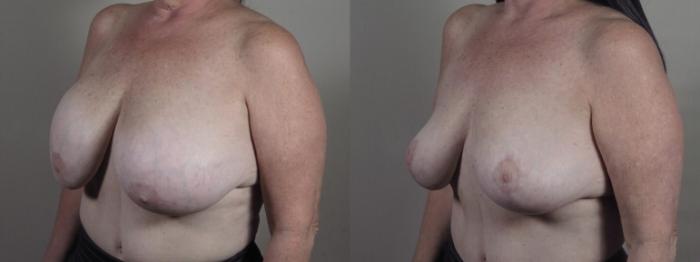 Breast Implant Removal Case 1239 Before & After Left Side | Paramus, New Jersey | Parker Center for Plastic Surgery
