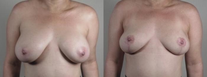 Breast Implant Removal Case 1244 Before & After Front | Paramus, New Jersey | Parker Center for Plastic Surgery