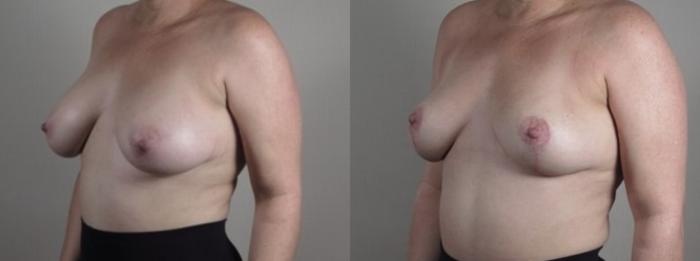Breast Implant Removal Case 1244 Before & After Left Oblique | Paramus, New Jersey | Parker Center for Plastic Surgery