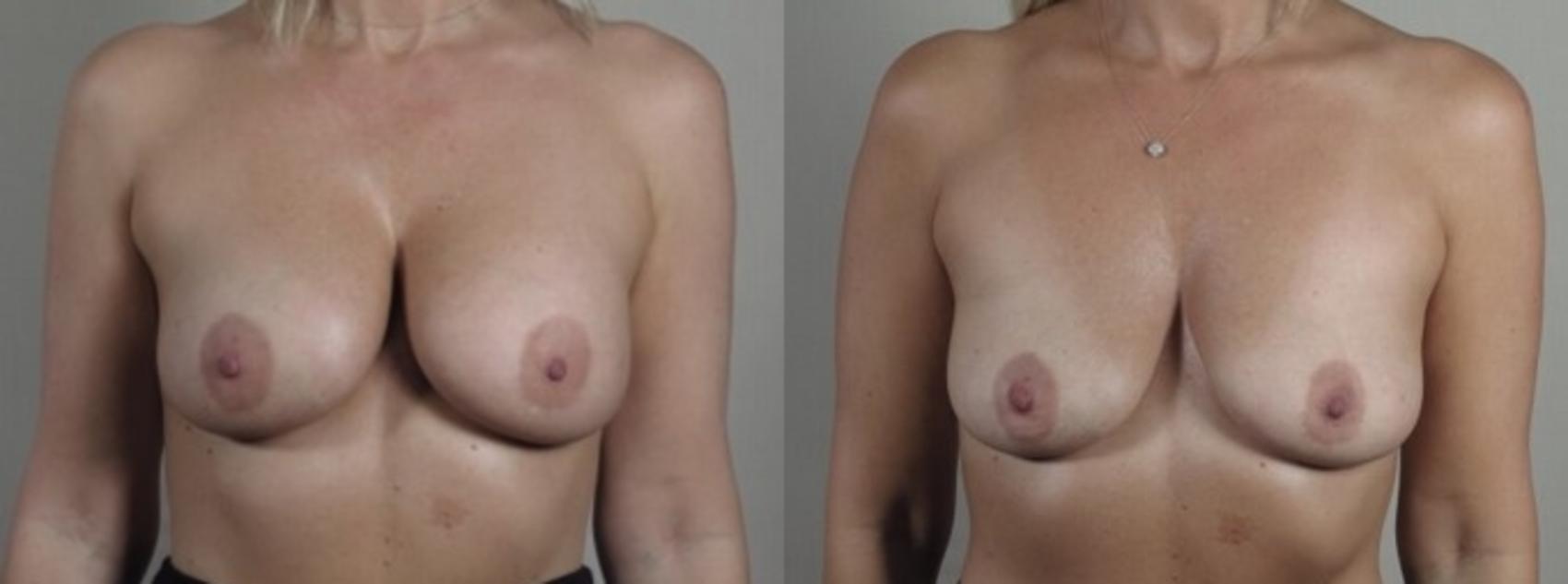 Breast Implant Removal Case 1245 Before & After Front | Paramus, New Jersey | Parker Center for Plastic Surgery