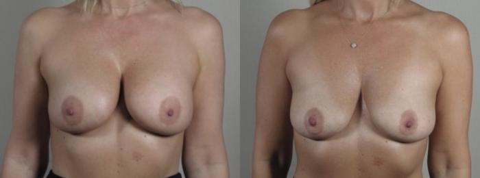 Breast Implant Removal Case 1245 Before & After Front | Paramus, New Jersey | Parker Center for Plastic Surgery