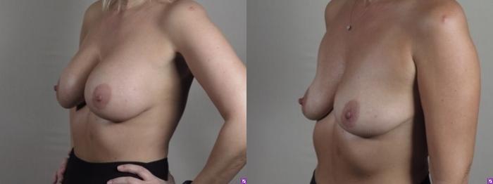 Breast Implant Removal Case 1245 Before & After Left Oblique | Paramus, New Jersey | Parker Center for Plastic Surgery