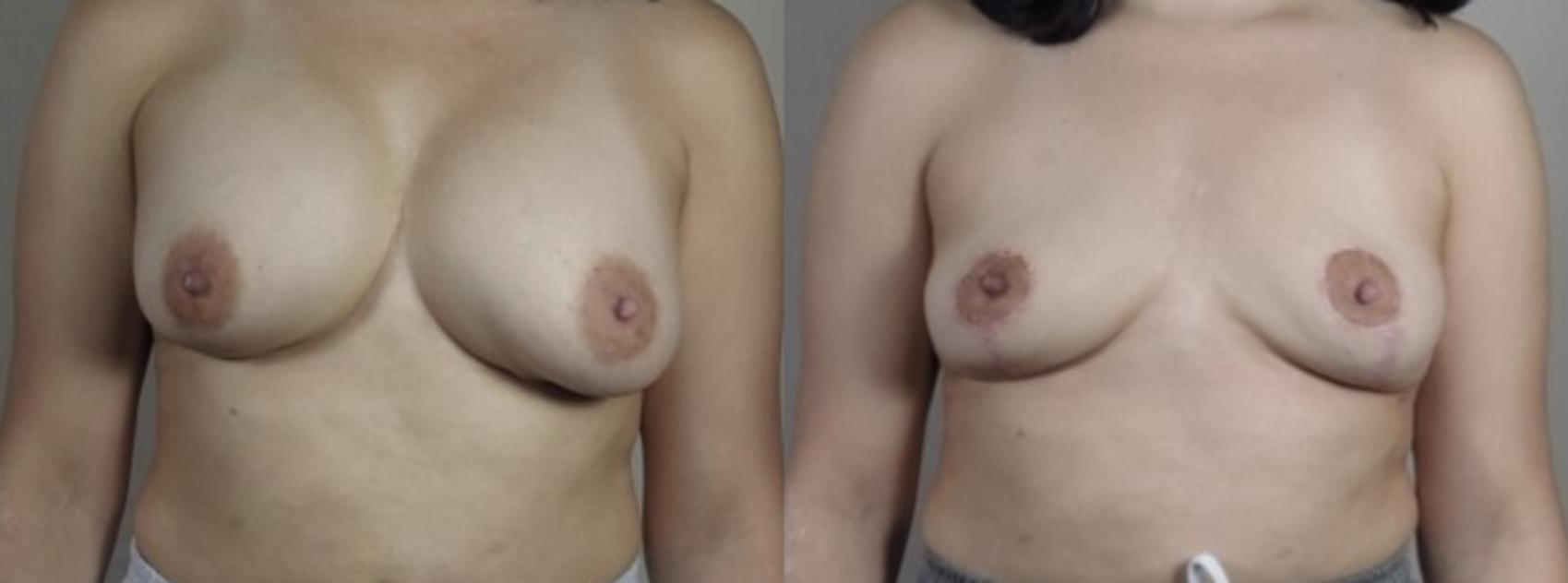 Breast Implant Removal Case 1246 Before & After Front | Paramus, New Jersey | Parker Center for Plastic Surgery
