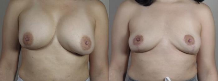 Breast Implant Removal Case 1246 Before & After Front | Paramus, New Jersey | Parker Center for Plastic Surgery