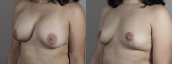 Breast Implant Removal Case 1246 Before & After Left Oblique | Paramus, New Jersey | Parker Center for Plastic Surgery