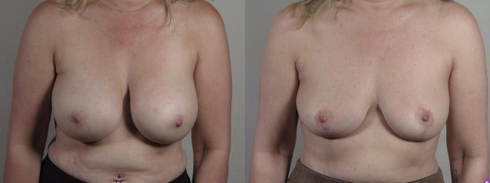 Breast Implant Removal Case 1248 Before & After Front | Paramus, New Jersey | Parker Center for Plastic Surgery