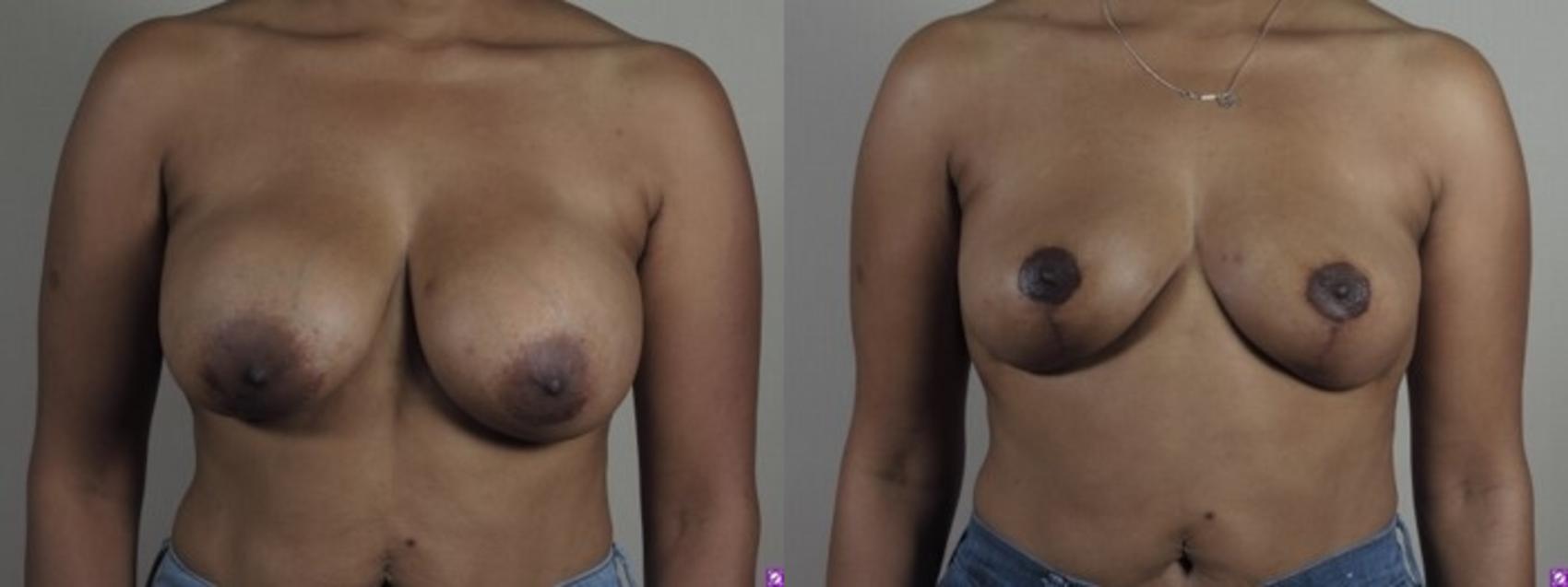 Breast Implant Removal Case 1249 Before & After Front | Paramus, New Jersey | Parker Center for Plastic Surgery