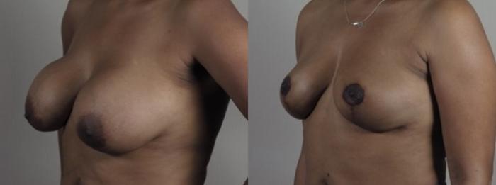 Breast Implant Removal Case 1249 Before & After Left Oblique | Paramus, New Jersey | Parker Center for Plastic Surgery
