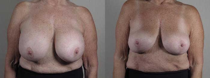 Breast Implant Removal Case 1268 Before & After Front | Paramus, New Jersey | Parker Center for Plastic Surgery