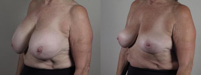 Breast Implant Removal Case 1268 Before & After Left Oblique | Paramus, New Jersey | Parker Center for Plastic Surgery