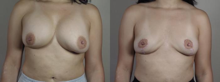 Breast Implant Removal Case 1278 Before & After Front | Paramus, New Jersey | Parker Center for Plastic Surgery