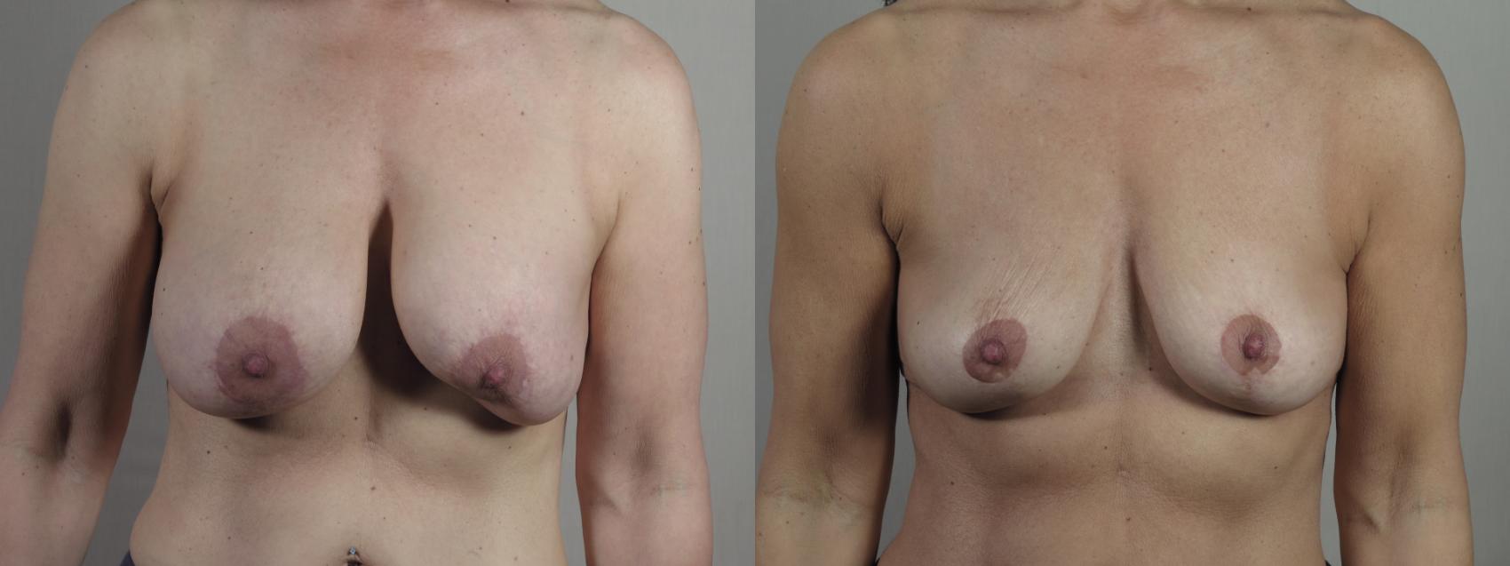 Breast Implant Removal Case 1344 Before & After Front | Paramus, New Jersey | Parker Center for Plastic Surgery