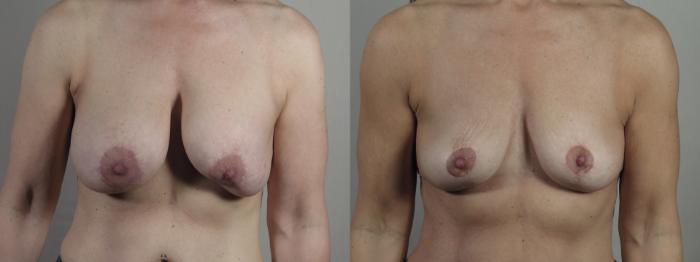 Breast Implant Removal Case 1344 Before & After Front | Paramus, New Jersey | Parker Center for Plastic Surgery