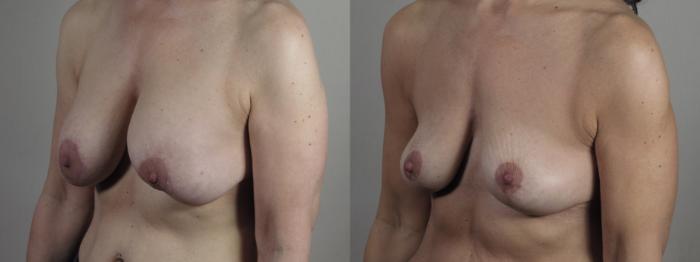 Breast Implant Removal Case 1344 Before & After Left Oblique | Paramus, New Jersey | Parker Center for Plastic Surgery