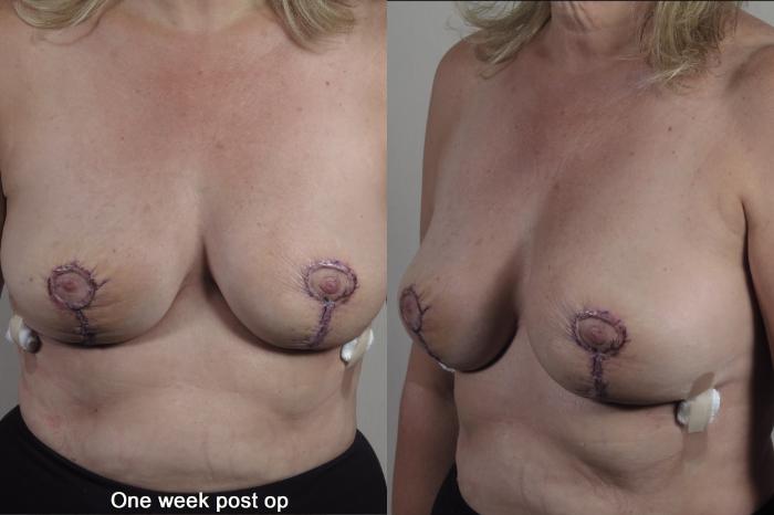 Breast Implant Removal Case 1360 Before & After 1 week  | Paramus, New Jersey | Parker Center for Plastic Surgery
