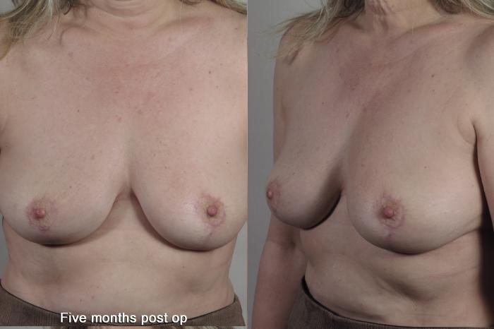 Breast Implant Removal Case 1360 Before & After months  | Paramus, New Jersey | Parker Center for Plastic Surgery
