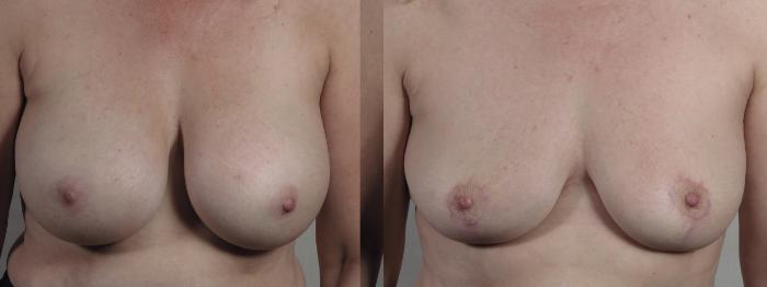 Breast Implant Removal Case 1360 Before & After pre op  | Paramus, New Jersey | Parker Center for Plastic Surgery