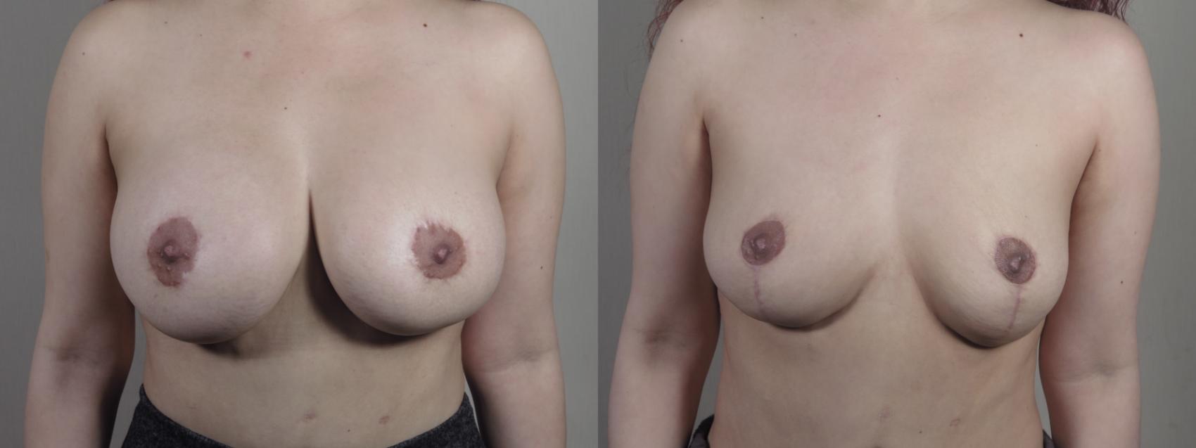 Breast Implant Removal Case 1370 Before & After Front | Paramus, New Jersey | Parker Center for Plastic Surgery