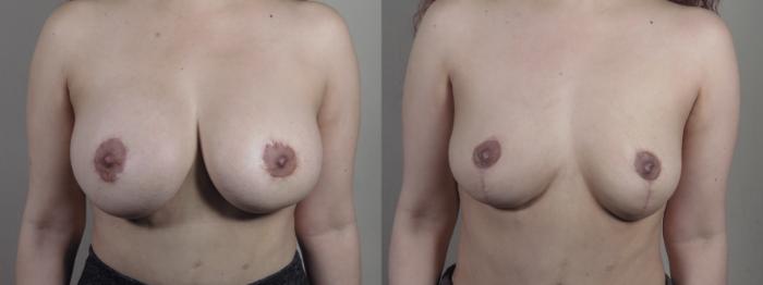 Breast Implant Removal Case 1370 Before & After Front | Paramus, New Jersey | Parker Center for Plastic Surgery