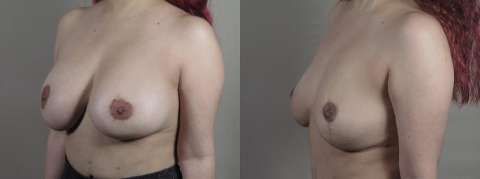 Breast Implant Removal Case 1370 Before & After Left Oblique | Paramus, New Jersey | Parker Center for Plastic Surgery