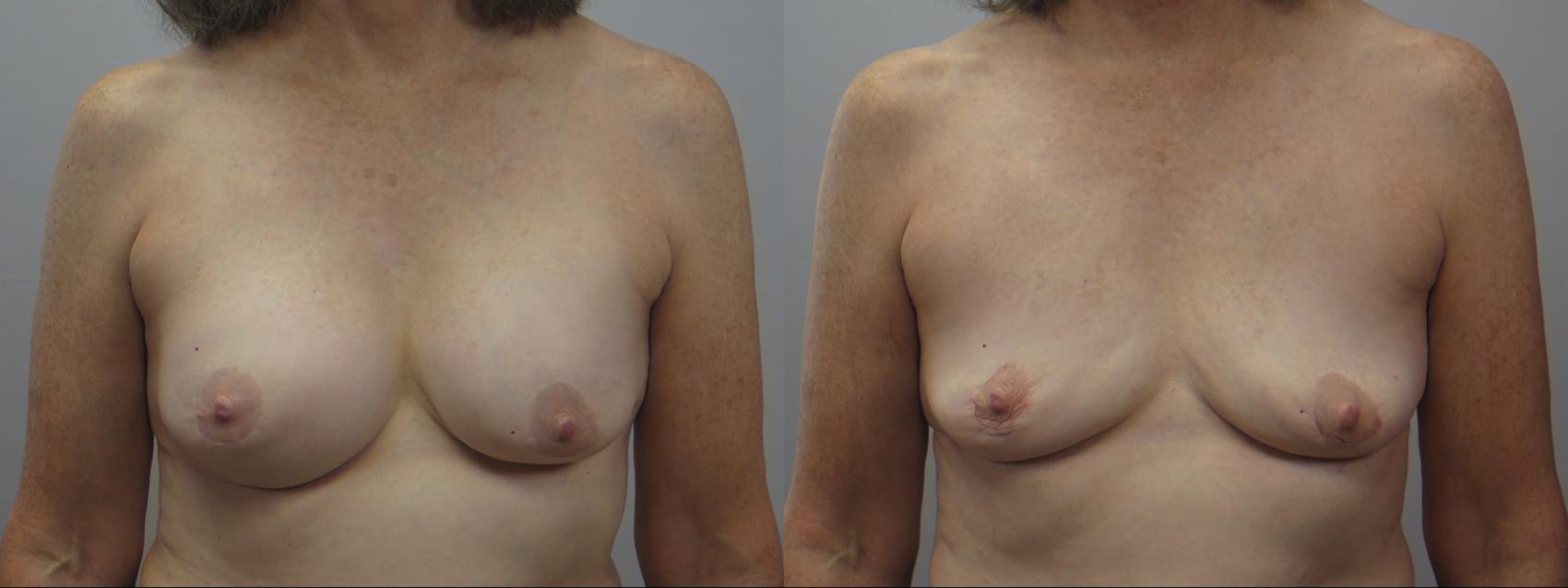 Breast Implant Removal Case 1638 Before & After Front | Paramus, New Jersey | Parker Center for Plastic Surgery