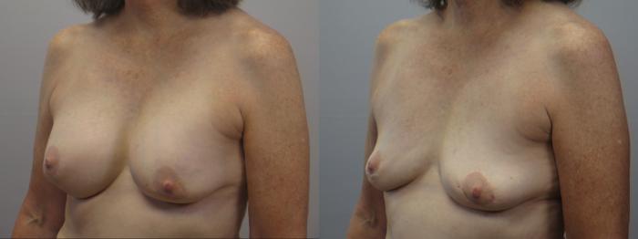 Breast Implant Removal Case 1638 Before & After Left Oblique | Paramus, New Jersey | Parker Center for Plastic Surgery
