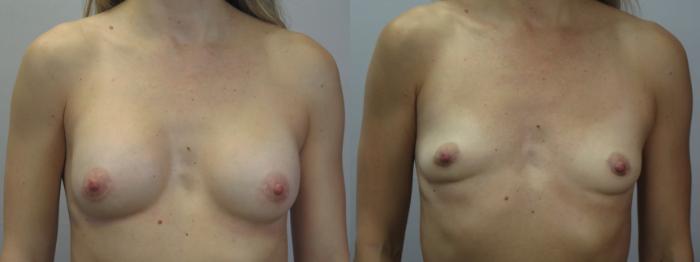 Breast Implant Removal Case 1640 Before & After Front | Paramus, New Jersey | Parker Center for Plastic Surgery