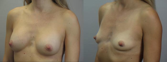 Breast Implant Removal Case 1640 Before & After Left Oblique | Paramus, New Jersey | Parker Center for Plastic Surgery