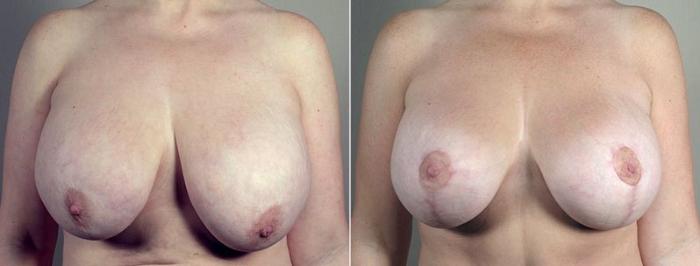 Breast Implant Removal Case 553 Before & After View #1 | Paramus, New Jersey | Parker Center for Plastic Surgery