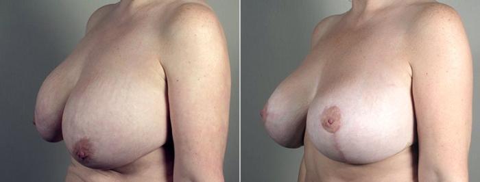 Breast Implant Removal Case 553 Before & After View #2 | Paramus, New Jersey | Parker Center for Plastic Surgery