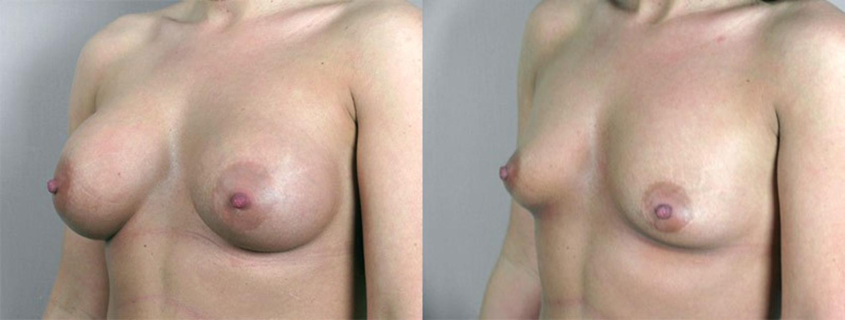 Breast Implant Removal Case 573 Before & After View #2 | Paramus, New Jersey | Parker Center for Plastic Surgery