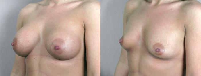 Breast Implant Removal Case 573 Before & After View #2 | Paramus, New Jersey | Parker Center for Plastic Surgery