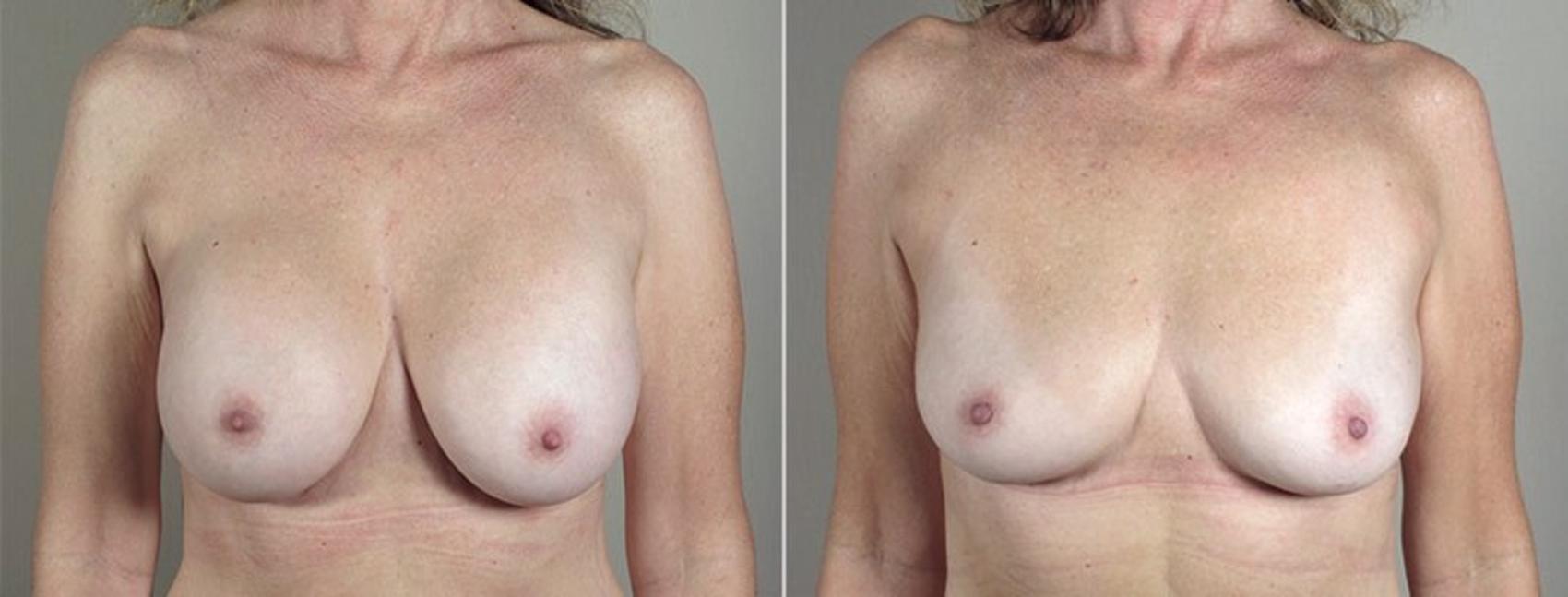 Breast Implant Removal Case 574 Before & After View #1 | Paramus, New Jersey | Parker Center for Plastic Surgery