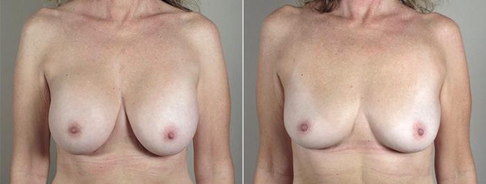 Breast Implant Removal Case 574 Before & After View #1 | Paramus, New Jersey | Parker Center for Plastic Surgery