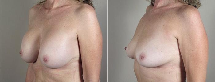 Breast Implant Removal Case 574 Before & After View #2 | Paramus, New Jersey | Parker Center for Plastic Surgery