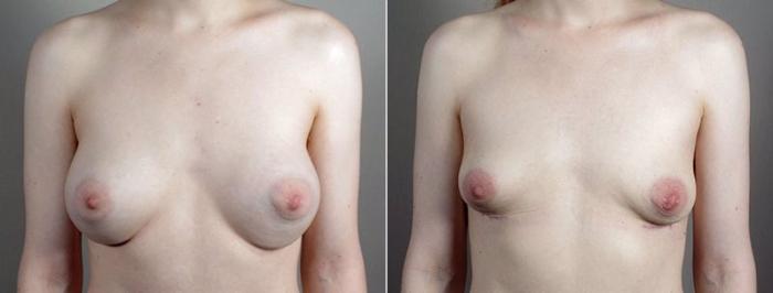 Breast Implant Removal Case 575 Before & After View #1 | Paramus, New Jersey | Parker Center for Plastic Surgery