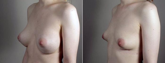 Breast Implant Removal Case 575 Before & After View #2 | Paramus, New Jersey | Parker Center for Plastic Surgery