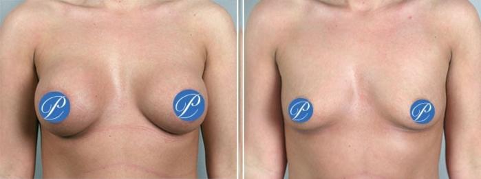 Breast Implant Removal Case 908 Before & After View #5 | Paramus, New Jersey | Parker Center for Plastic Surgery