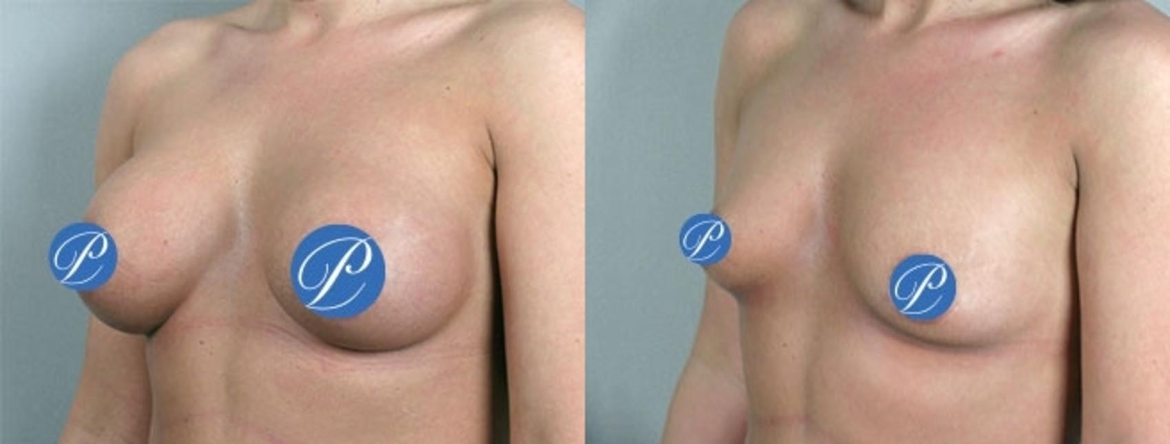 Breast Implant Removal Case 908 Before & After View #side1 | Paramus, New Jersey | Parker Center for Plastic Surgery