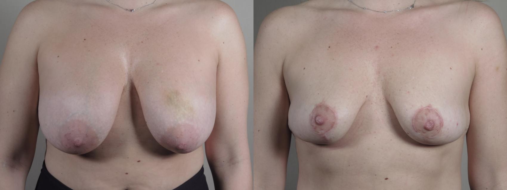 Breast Implant Removal Case 983 Before & After Front | Paramus, New Jersey | Parker Center for Plastic Surgery