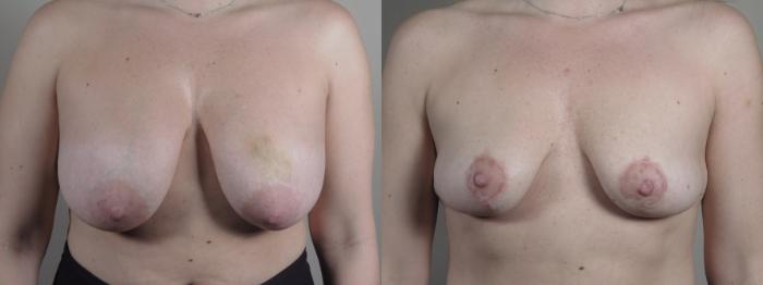 Breast Implant Removal Case 983 Before & After Front | Paramus, New Jersey | Parker Center for Plastic Surgery