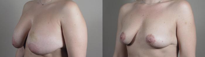 Breast Implant Removal Case 983 Before & After Right Oblique | Paramus, New Jersey | Parker Center for Plastic Surgery