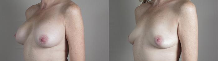 Breast Implant Removal Case 991 Before & After Right Oblique | Paramus, New Jersey | Parker Center for Plastic Surgery