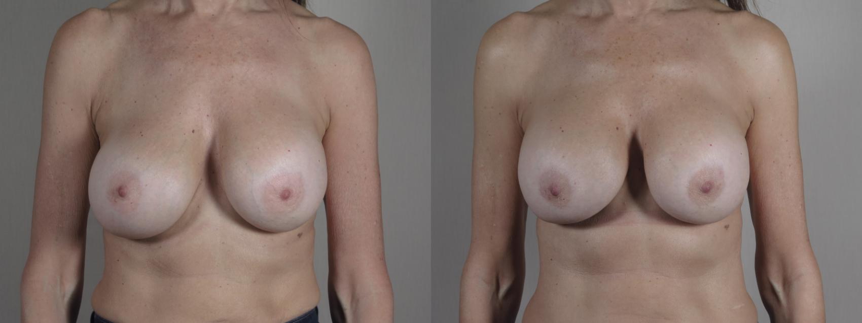 Breast Implant Revision Case 1025 Before & After Front | Paramus, New Jersey | Parker Center for Plastic Surgery