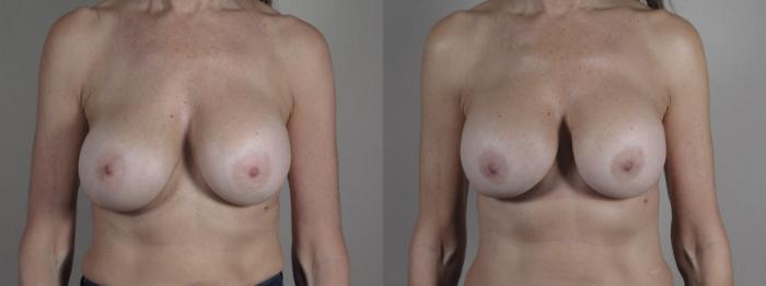 Breast Implant Revision Case 1025 Before & After Front | Paramus, New Jersey | Parker Center for Plastic Surgery