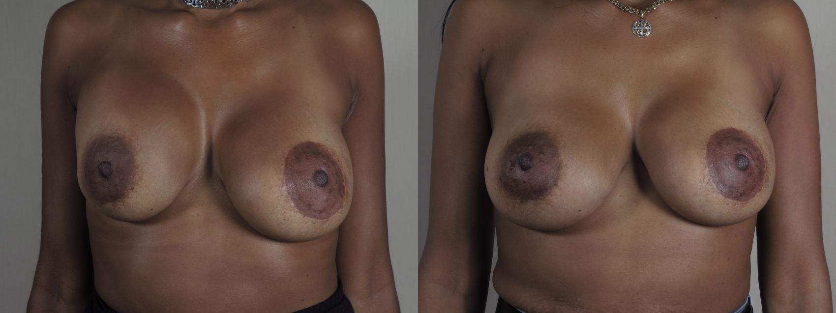 Breast Implant Revision Case 1199 Before & After View #1  | Paramus, New Jersey | Parker Center for Plastic Surgery
