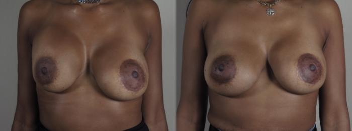 Breast Implant Revision Case 1199 Before & After View #1  | Paramus, New Jersey | Parker Center for Plastic Surgery