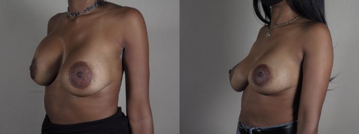 Breast Implant Revision Case 1199 Before & After View #2 | Paramus, New Jersey | Parker Center for Plastic Surgery