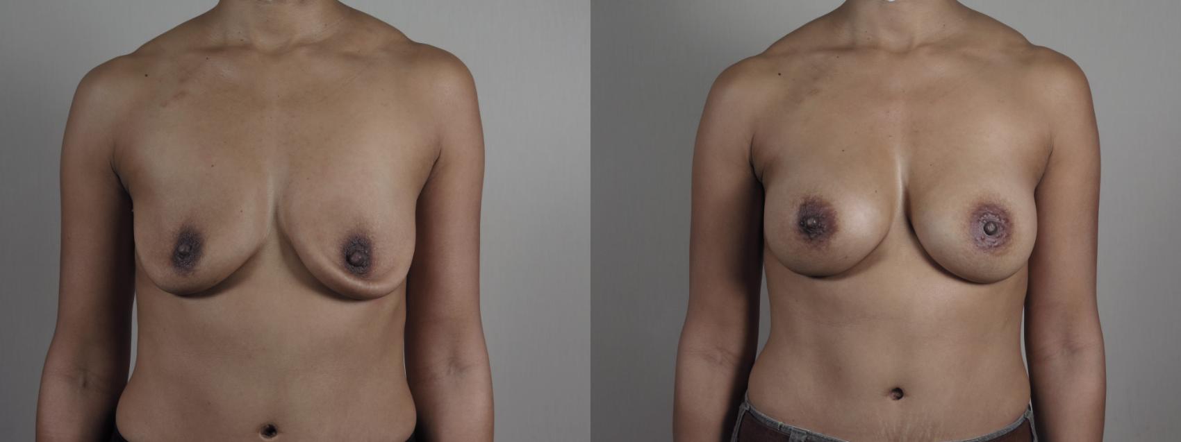 Breast Implant Revision Case 1204 Before & After View #1  | Paramus, New Jersey | Parker Center for Plastic Surgery