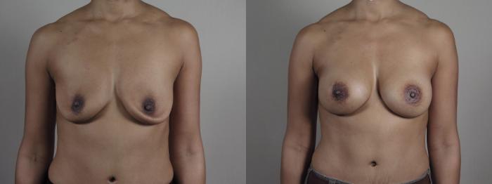 Breast Implant Revision Case 1204 Before & After View #1  | Paramus, New Jersey | Parker Center for Plastic Surgery